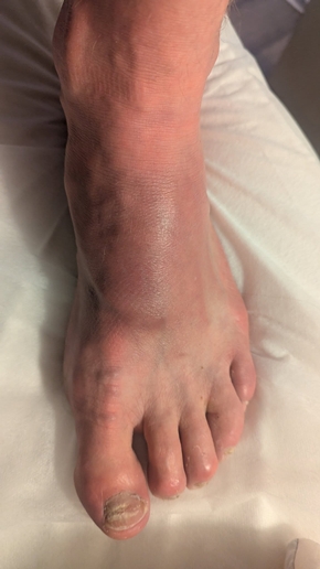 My injured foot